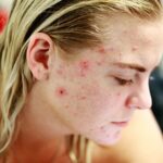 O que é acne hormonal e como tratá-la