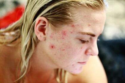 O que é acne hormonal e como tratá-la