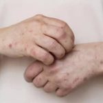 Sarampo: RJ confirma primeiro caso da doença em 2026