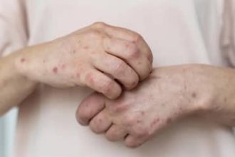 Sarampo: RJ confirma primeiro caso da doença em 2026