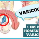 Varicocele: o que é importante saber?