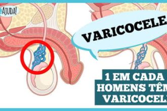 Varicocele: o que é importante saber?