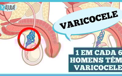 Varicocele: o que é importante saber?