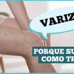 Varizes: não é só estética é saúde vascular