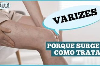 Varizes: não é só estética é saúde vascular