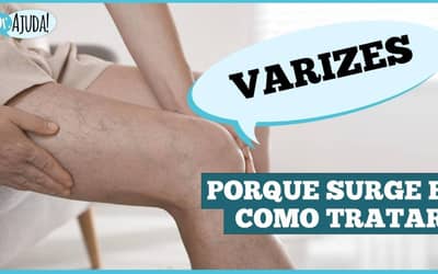 Varizes: não é só estética é saúde vascular